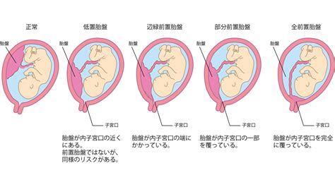 胎盤形成出血 官印高透格